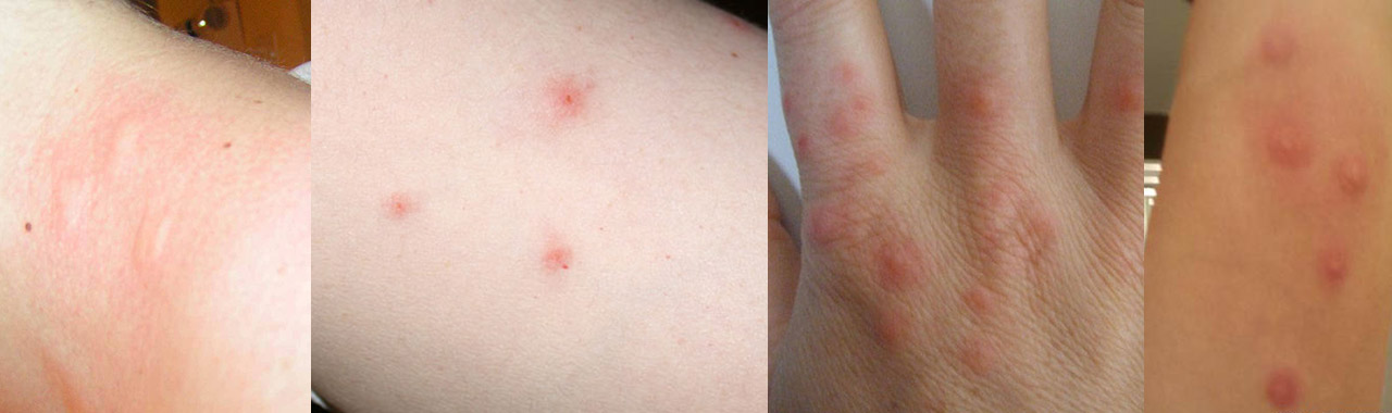 Bed Bugs Bites Pictures Burlington Hamilton Green Heat Bed Bugs